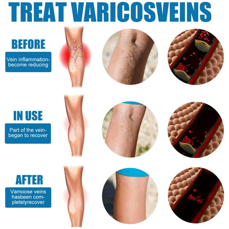 Varicose Veins Spray.