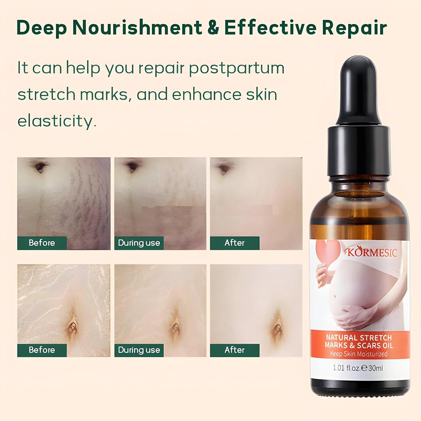 KORMESIC Repair Oil Treatment Stretch Marks