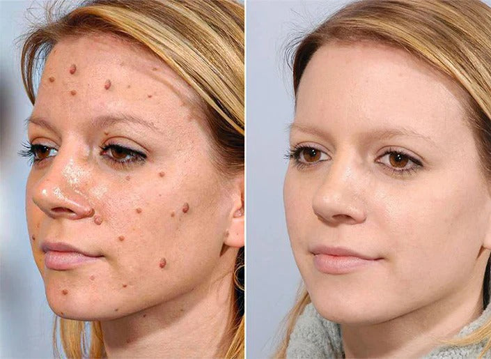 TagRecede Bee Venom Treatment Spray TK