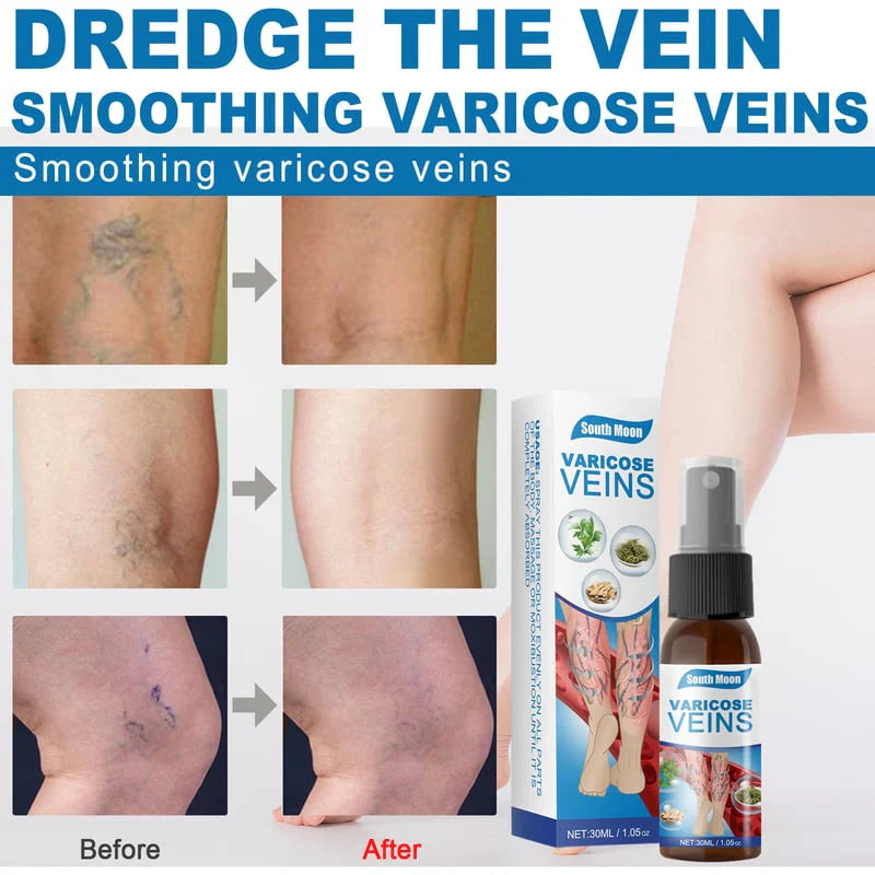 Varicose Veins Spray.